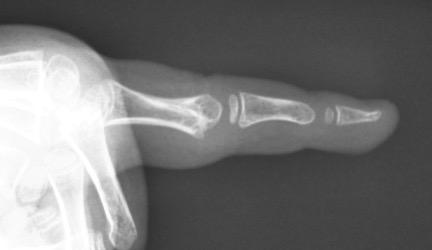 Phalangeal neck fractures Percutaneous osteoclasis & pinning for late-presenting fractures Waters et al,