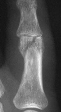 3. Intercondylar phalangeal fracture Intra-articular fracture Malunion à deformity,