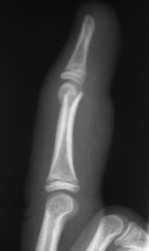 2. Phalangeal neck fractures Sports or doorjamb injuries X-rays findings subtle Closed