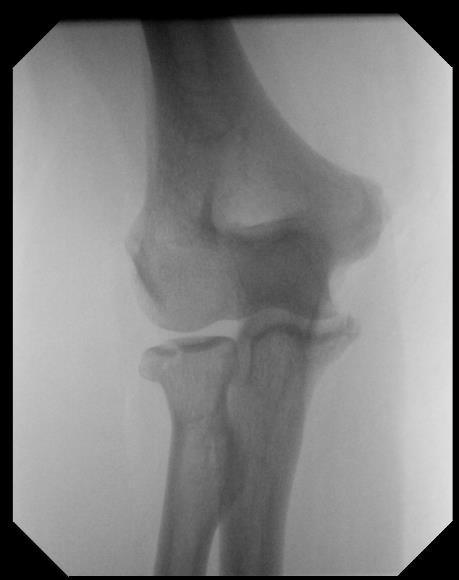 Elbow fractures Complex articulation of bones with unique