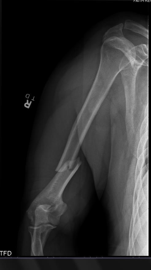 Humerus fractures Proximal Shaft