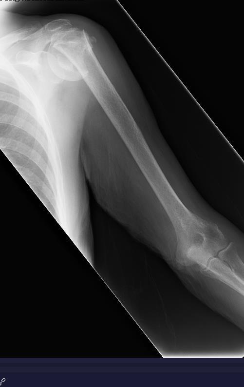 Proximal humerus fractures Tolerate a