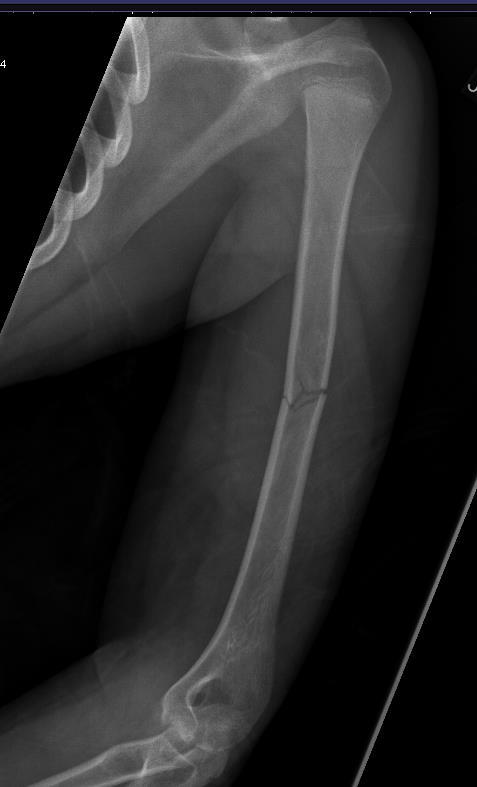 Humeral Shaft Non-operative Non-displaced closed simple fractures Displaced closed fractures with