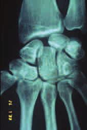 RADIAL-SIDED WRIST PAIN 3) Rotatory Subluxation of the scaphoid