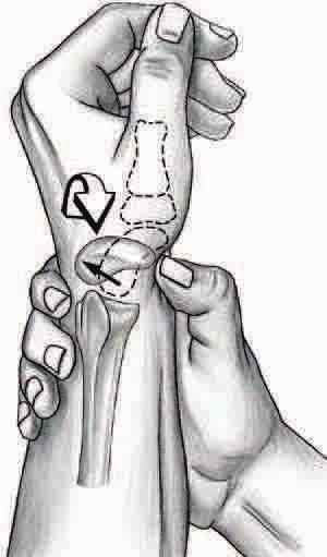 RADIAL-SIDED WRIST PAIN 3) Rotatory Subluxation of the scaphoid Watson's maneuver : Pressure applied over scaphoid