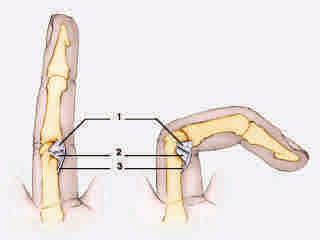PROXIMAL INTERPHALANGEAL JOINT INJURIES Football,
