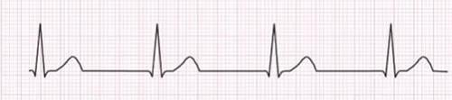 Junctional Rhythm Rhythm: Regular Ventricular Rate: 41-60 bpm P Wave: inverted, absent, inverted after QRS Atrial Rate: 41-60 PR Interval: <0.12 seconds QRS Interval: <0.