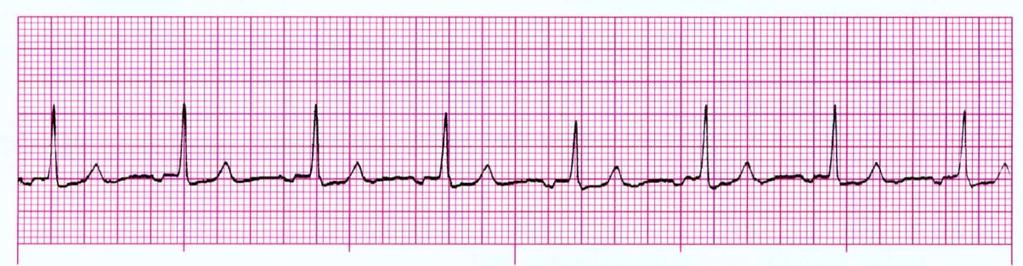 Accelerated Junctional Rhythm Rhythm: Regular Ventricular Rate: 61-100 bpm P Wave: inverted, absent, inverted after QRS Atrial Rate: 61-100 bpm PR Interval: <0.12 seconds QRS Interval: <0.
