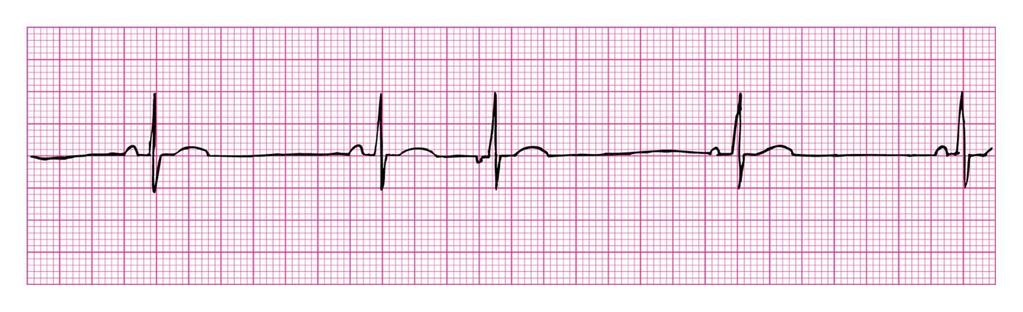 Premature Junctional Contraction Rhythm: Usually regular Ventricular Rate: underlying rhythm P Wave: inverted, absent, or inverted after the QRS Atrial Rate: underlying rhythm PR Interval: <0.