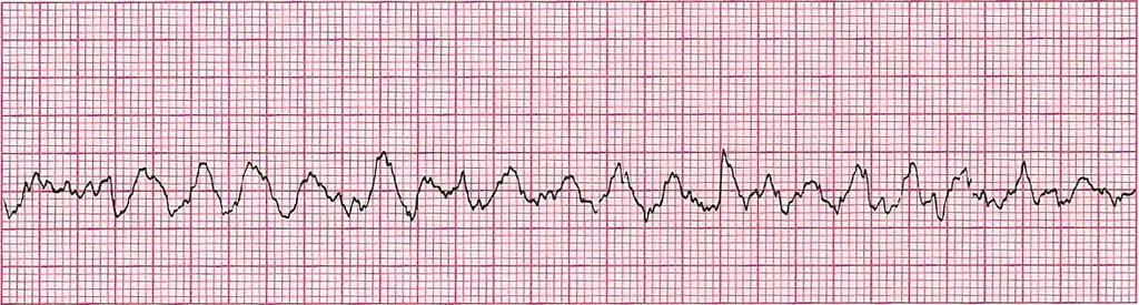 Ventricular Fibrillation Rhythm: Chaotic Ventricular Rate: NA P Wave: NA Atrial Rate: NA PR Interval: NA QRS Interval: NA Most common cause of death for people with coronary heart disease Most common