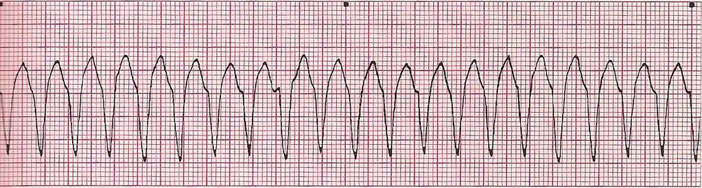 Ventricular Tachycardia Rhythm: Regular Ventricular Rate: >101 bpm P Wave: none Atrial Rate: none PR Interval: NA QRS Interval: 0.