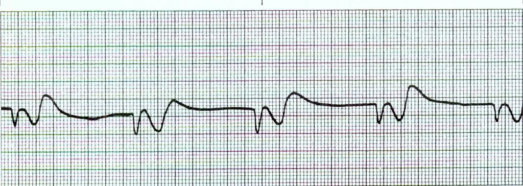 Idioventricular Rhythm Rhythm: Regular Ventricular Rate: 21-40 bpm P Wave: NA Atrial Rate: NA PR Interval: NA QRS Interval: 0.