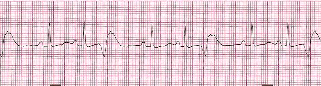 Premature Ventricular Contraction Rhythm: underlying rhythm Ventricular Rate: underlying rhythm P Wave: absent on premature beat Atrial Rate: underlying rhythm PR Interval: none QRS Interval: 0.