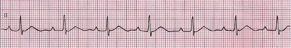 Sinus Rhythm with First-Degree Heart Block Rhythm: Regular Ventricular Rate: 60-100 bpm P Wave: upright, matching, 1:1 Atrial Rate: 60-100 bpm PR Interval: > 0.20 seconds QRS Interval: < 0.