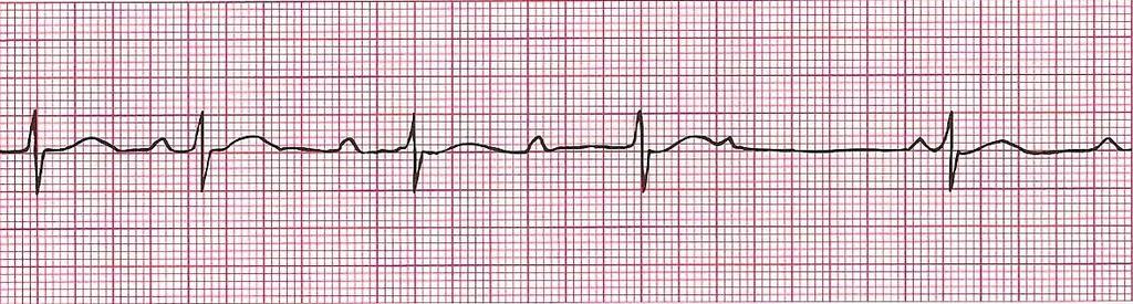 Second-Degree Heart Block Type 1 (Wenkebach) Rhythm: Ventricular-Irregular/Regular Atrial-Regular Ventricular Rate: varies P Wave: upright, matching Atrial Rate: varies PR Interval: progressively