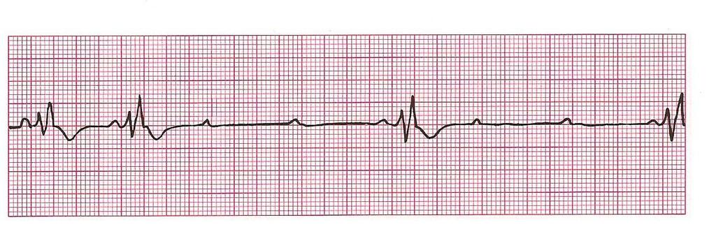 Second-Degree Heart Block Type 2 Rhythm: Ventricular-Regular/Irregular Atrial-Regular Ventricular Rate: Vary P Wave: upright, matching, 2:1, 3:1, 4:1 Atrial Rate: varies PR Interval: constant QRS