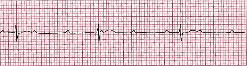 Third-Degree Heart Block (Complete) Rhythm: Ventricular-Regular Atrial-Regular Ventricular Rate: varies P Wave: upright, matching Atrial Rate: varies PR Interval: varies QRS Interval: < 0.