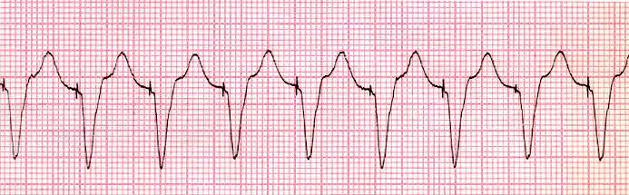 Ventricular Pacing Chamber Paced: Ventricle Interpretation: Normal V-Pacing Bradycardia Third Degree Heart Block Pauses Overdrive of