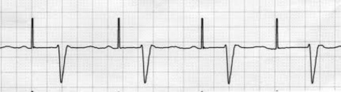 Failure to Capture Chamber Paced: Unknown Interpretation: Failure to capture Bradycardia Third Degree Heart Block Pauses Overdrive of tachyarrythmias