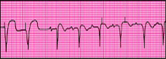 Undersensing Chamber Paced: Ventricular Interpretation: V-Paced with undersensing Bradycardia Third Degree Heart Block Pauses Overdrive of tachyarrythmias Prophylactic for heart