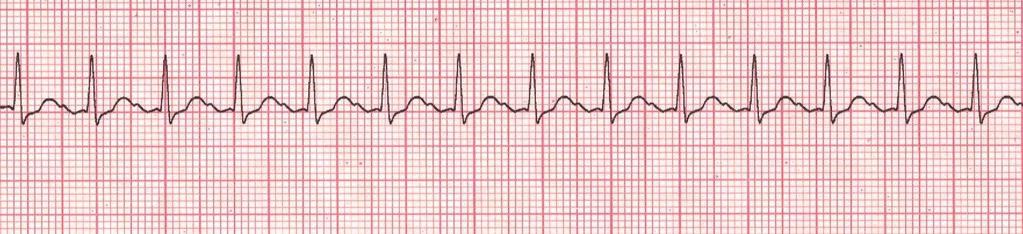 Sinus Tachycardia Rhythm: Regular Ventricular Rate: 101-150 P Wave: upright, matching, 1:1 Atrial Rate: 101-150 PR Interval: 0.12-0.20 seconds QRS Interval: < 0.
