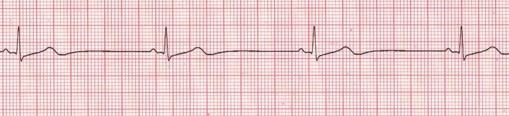 Sinus Bradycardia Rhythm: Regular Ventricular Rate: < 60 bpm P Wave: upright, matching, 1:1 Atrial Rate: < 60 bpm PR Interval: 0.12-0.20 seconds QRS Interval: < 0.