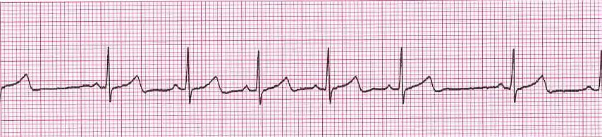 Sinus Arrhythmia Rhythm: Irregular Ventricular Rate: any rate P Wave: upright, matching, 1:1 Atrial Rate: any rate PR Interval: 0.12-0.20 seconds QRS Interval: <0.