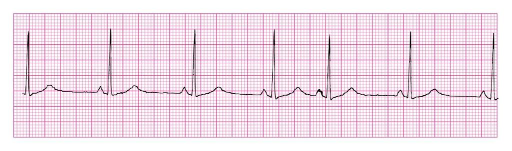 Premature Atrial Contraction(PAC) Rhythm: that of underlying rhythm Ventricular Rate: that of underlying P Wave: upright, abnormal in size and shape, p wave may be in T wave Atrial Rate: that of
