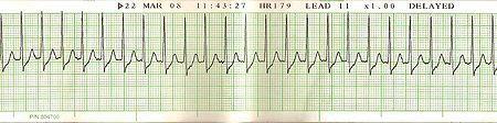 Paroxysmal Supraventricular Tachycardia (PSVT or SVT) Rhythm: Regular Ventricular Rate: > 150 bpm P Wave: unable to see Atrial Rate: NA PR Interval: NA QRS Interval: <0.