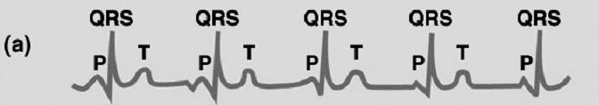 Normal ECG: P waves (atrial depolarization) are followed faithfully by QRS