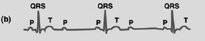 1st degree heart block ECG: PR segment is longer than normal 2nd degree heart block