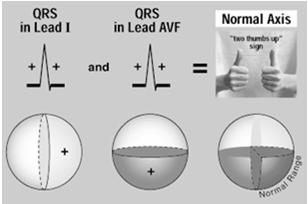 normal HR THE QRS AXIS Represents the overall direction of the