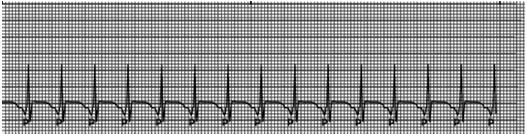 P -wave in same direction as QRS If P -wave is down-going II, II,