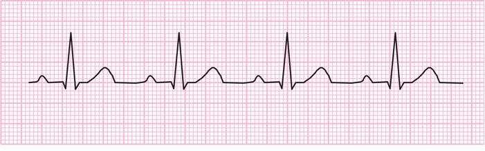 First-Degree Heart Block Regularity: Regular P wave: Normal PR interval: