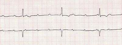 Third-Degree Heart Block Rate: Separate rates for underlying (sinus) rhythm and escape rhythm Regularity: Regular, but P rate and QRS rates