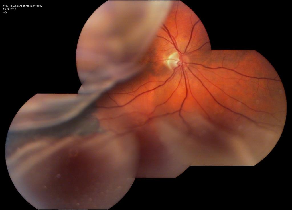RISK FACTORS FOR TUMOR SIZE PROXIMITY TO THE OPTIC DISC/MACULA UVEAL