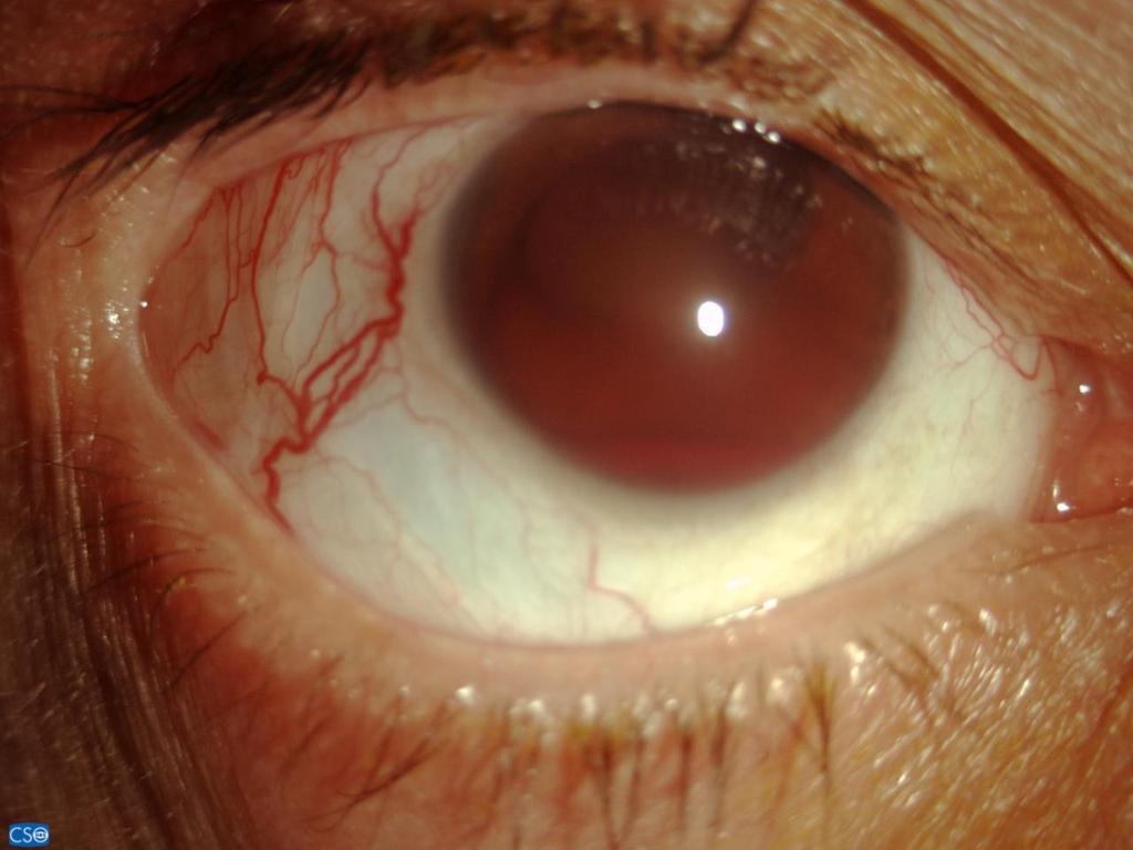TREATMENT OF SURGERY FOR GLAUCOMA SURGERY FOR