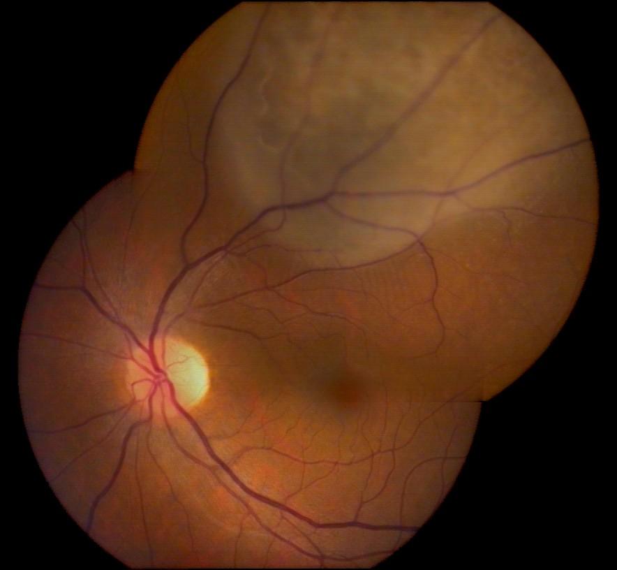 for choroidal melanoma have shifted from enucleation