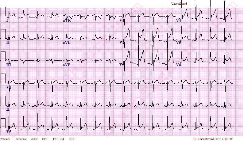Pericarditis A 78-year-old man with a past history remarkable only for gout is seen because of the acute onset of chest pain.