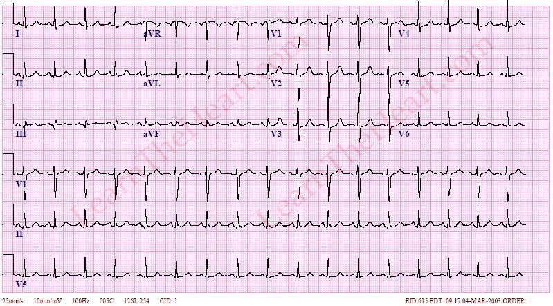 Pulmonary Embolism 35 year old female with smoking history presents with sudden onset of pleuritic chest pain and shortness