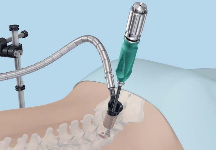 T-PAL and MIS Accommodates both open and MIS approaches Traditionally, TLIF surgery with kidney bean shaped implants often required stick trials, an implant inserter, straight impactors, angled