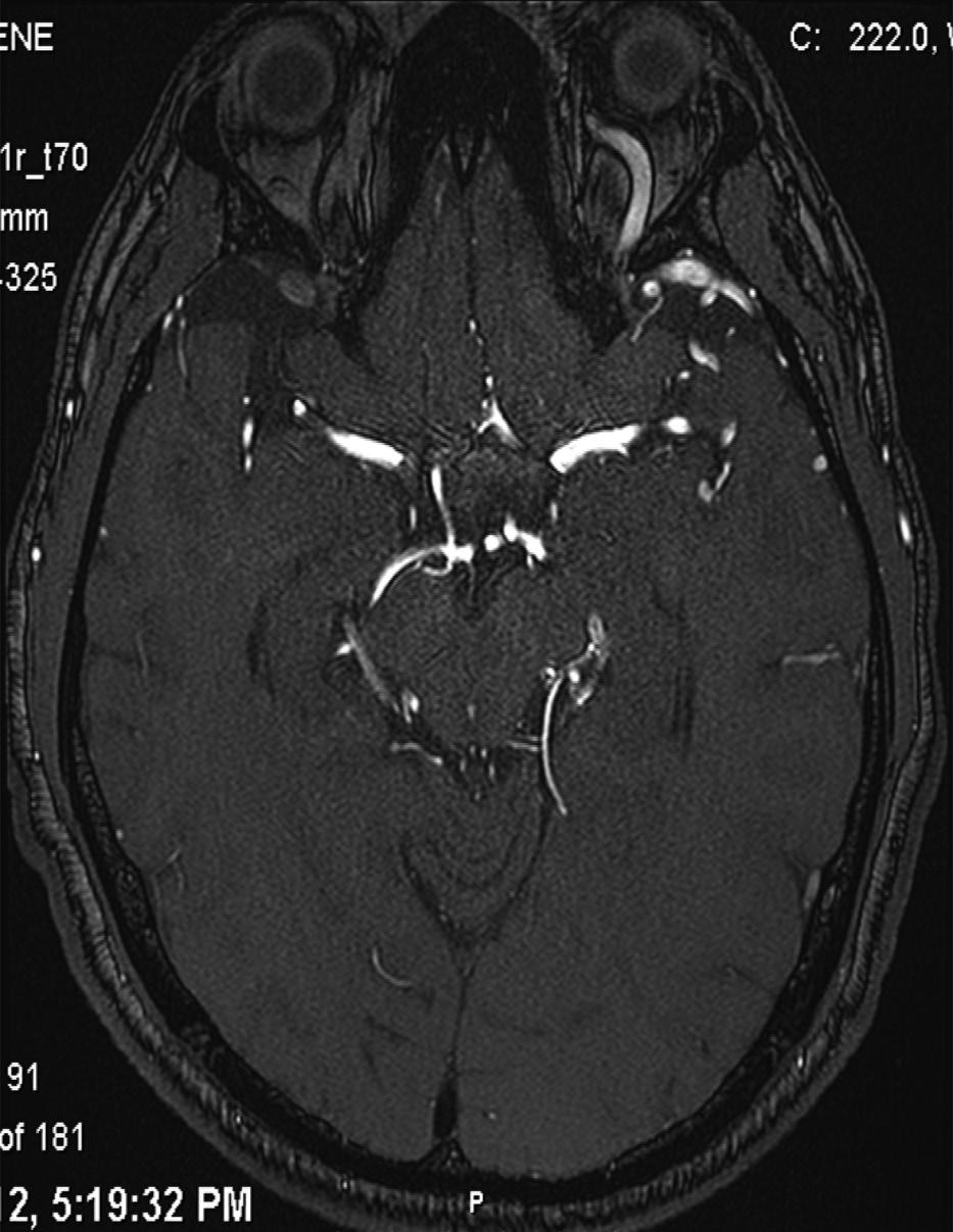 Background A dural arteriovenous fistula (DAVF), is an abnormal direct connection (fistula) between a meningeal artery and a meningeal vein or dural venous sinus.