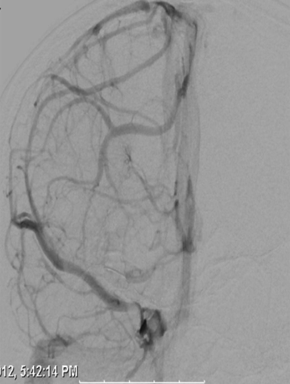 A C B Figure 2A C. Cerebral Angiogram Basal dural arteriovenous fistula of the posterior fossa.