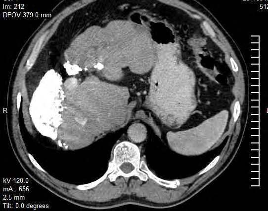 Differential Diagnosis of Hepatocellular Carcinoma on Computed Tomography 117 Fig. 10. Liver tuberculosis. Contrast enhanced CT image shows a large irregular miliary confluent calcification.