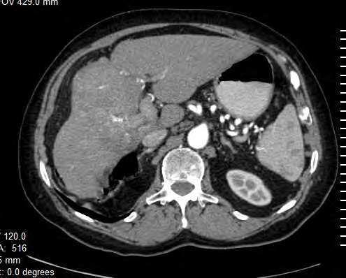 122 Hepatocellular Carcinoma Clinical Research consisting of collagen, fibrotic and sclerotic tissue and internal fatty components are seen in 2-21% of all cases (fig. 15)