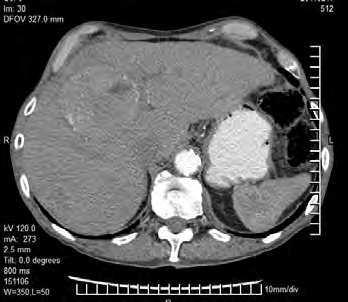 Differential Diagnosis of Hepatocellular Carcinoma on Computed Tomography 123 from other focal liver lesions, such as hepatic metastases, hepatic abscess, hepatic inflammatory pseudotumour and