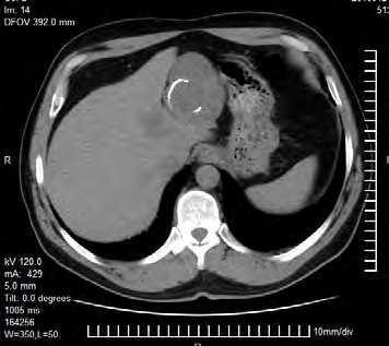 124 Hepatocellular Carcinoma Clinical Research The essential HCC diagnostic criteria on CT images are as follows: hypodense area on unenhanced CT images; homogenous or heterogeneous enhancement in