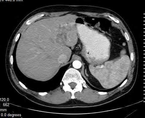 Differential Diagnosis of Hepatocellular Carcinoma on Computed Tomography 127 On precontrast CT images intraductal cholangiocarcinomas appear as a lesion within the dilated bile duct that is hypo-