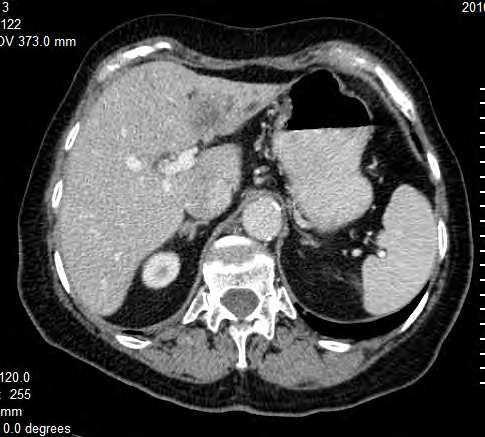 This is why they look hypodense on CT images, especially in portal venous phase compared to normal liver parenchyma. Central hypodense area caused by tissue necrosis may be seen on CT images (fig.22).