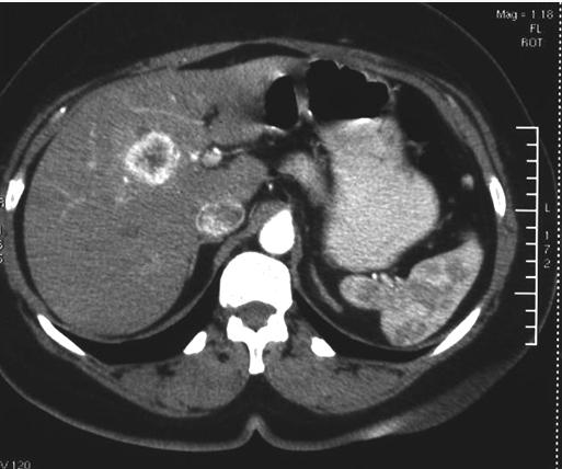 Differential Diagnosis of Hepatocellular Carcinoma on Computed Tomography 129 (c) Fig. 23. Hepatic metastasis from renal cell carcinoma.